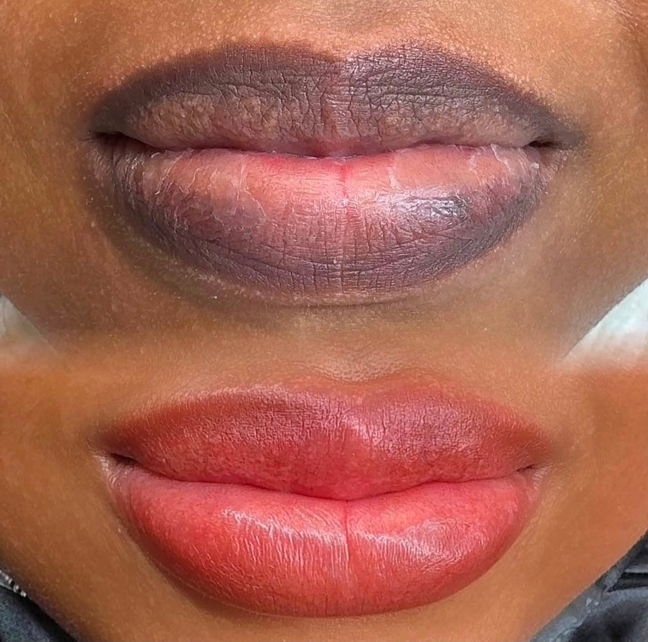 Lip Neutralisation
